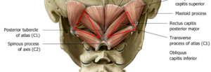 Treating Migraine Headaches (Part 3)